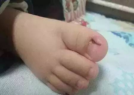 婴儿化脓甲沟炎最简单处理方法,宝宝甲沟炎指甲下有脓