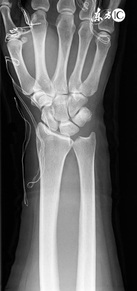 骨刺消痛液药方,一个骨刺的特效外敷药方