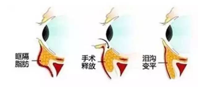 有泪沟怎么办最有效方法,有泪沟怎么办