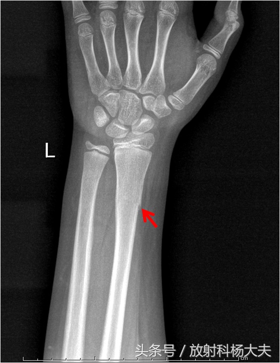 青枝骨折愈合大致分为三期,是不是所有的骨折都要手术