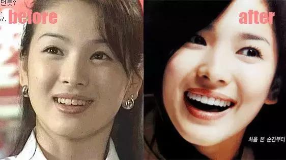 整牙=整容?看杨幂、刘涛、高圆圆为你亲身示范!