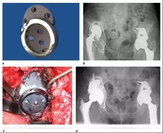 髋臼骨质破坏一般怎么治,髋臼骨缺损