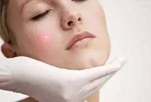 西京医院点痣哪个医生好,西京医院祛痣前后对比