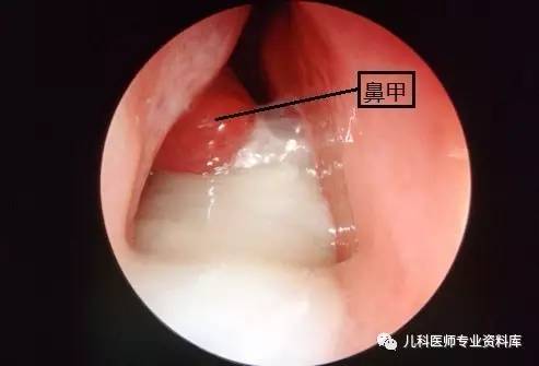 儿童鼻涕的秘密,儿童黄鼻涕粘稠