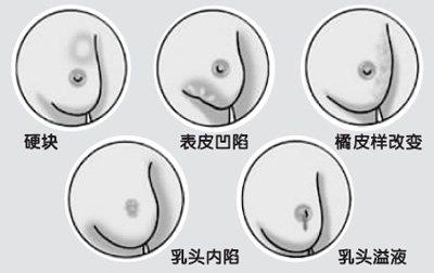 乳腺增生加囊肿的癌变几率和时间,乳腺导管上皮增生癌变几率