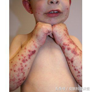 双小腿起红点不痛不痒是怎么回事,双小腿对称起红疹子痒是什么病