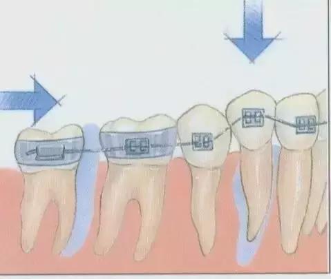 牙套上有钢丝怎么处理,钢丝牙套太丑怎么办