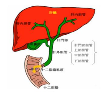 “小引流大作用”救命的胆道外引流管治疗晚期肿瘤性黄疸