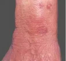 老人手臂有血瘀斑,老年人下肢皮下出血瘀斑且无症状