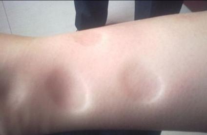 孕妇小腿浮肿怎么解决,孕妇小腿浮肿怎么回事