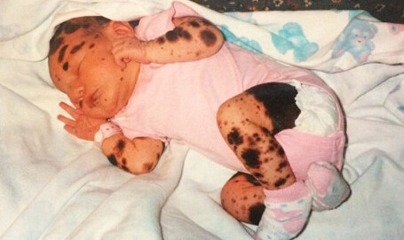 有没有治疗胎记特效药一天治好,胎记是夏天治疗好还是冬天治疗好