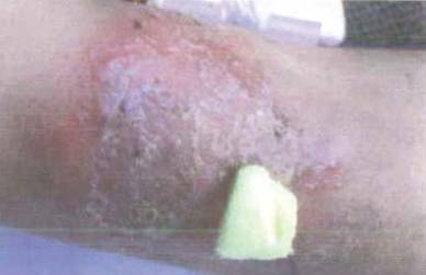 红色斑丘疹是湿疹吗,红斑丘疹误诊湿疹