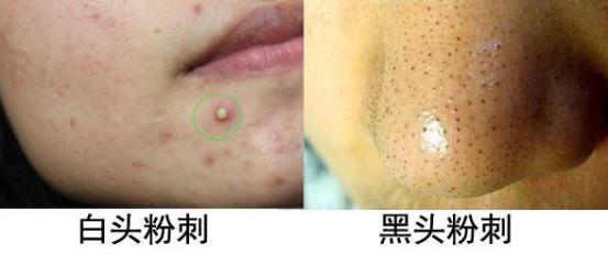 只有下巴反复长丘疹是什么原因,鼓起的硬痘痘