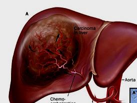 肝炎会变成癌吗,肝炎会转成肝硬化吗