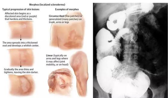 结缔组织病预兆,结缔组织病50岁死亡率高吗