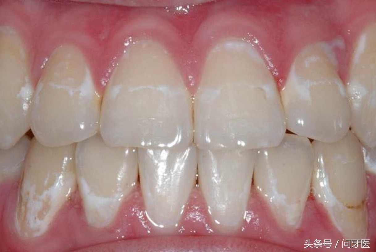 8岁孩子牙齿上有白斑怎么办,为什么牙齿会有白斑