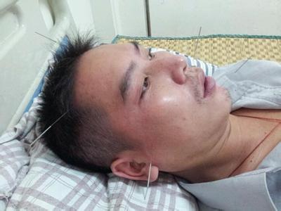 风把嘴吹歪了怎么回事,风把脸吹歪是什么原因