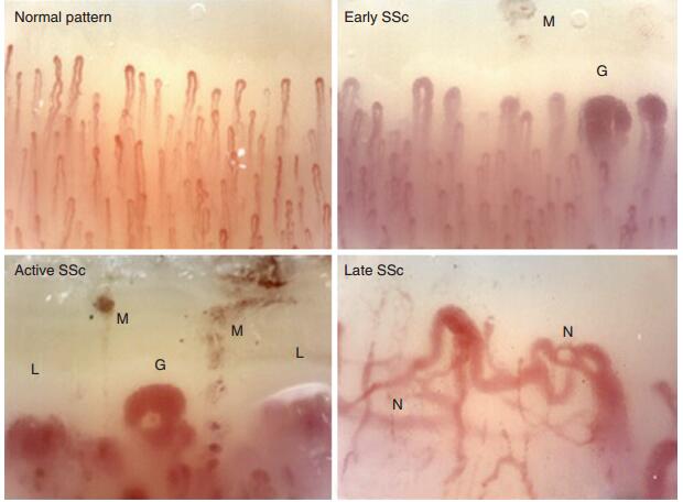 皮肌炎和多发性肌炎是什么样的疾病？