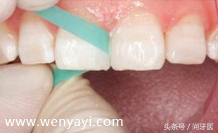 门牙有缝的女人有什么不好,门牙有缝怎么办如何补救