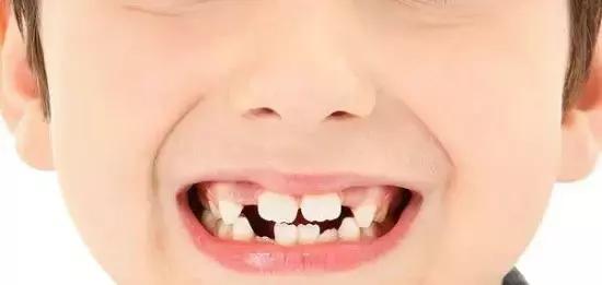 牙齿不齐凹进去,牙齿不齐有的地方刷不掉