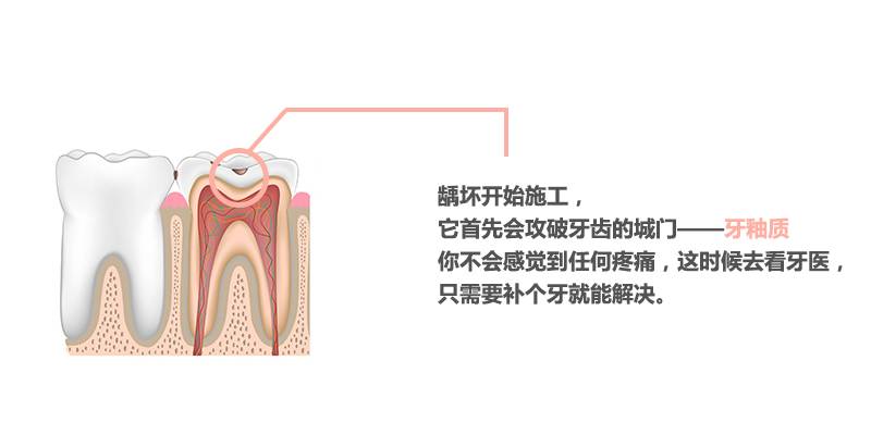 蛀牙不补怎么小洞变大了,蛀牙小洞不补大洞受罪