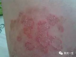 吸毒以后的后遗症有哪些症状,吸毒以后的后遗症都有什么