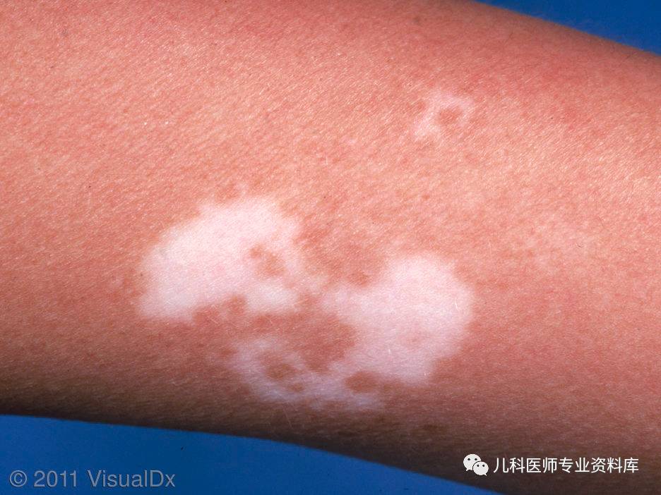 湿疹后有白斑是怎么回事,湿疹后白斑是白癜风