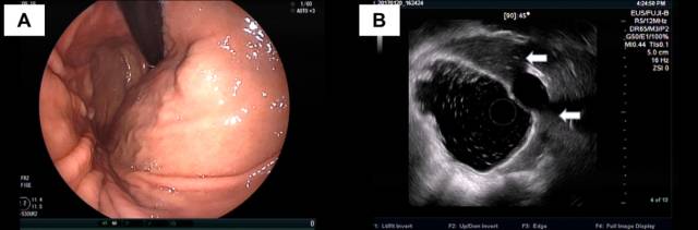 当EUS遇到“假瘤子”(二)——都是“隔壁老王”惹的祸(毗邻外压)