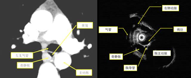 当EUS遇到“假瘤子”(二)——都是“隔壁老王”惹的祸(毗邻外压)