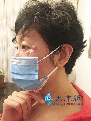 市民两万余元做美容眼睛周围起包流脓视力模糊