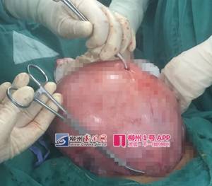 「惊呆」柳州一大妈肚子大得像怀孕7个月，医生打开后惊呆了……