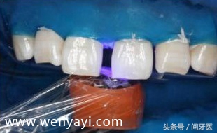 门牙有缝的女人有什么不好,门牙有缝怎么办如何补救