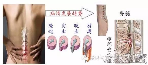 腰痛反射性腰痛,肾虚腰痛腰痛宁