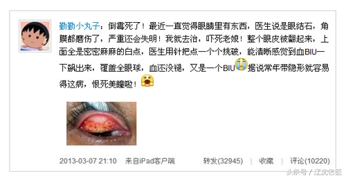 追剧、戴美瞳，女孩上眼皮长满“结石”，医生一针针刺破救眼睛