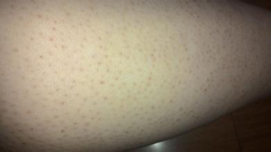 宝宝小腿毛孔粗大粗糙,婴儿腿上毛孔明显正常吗