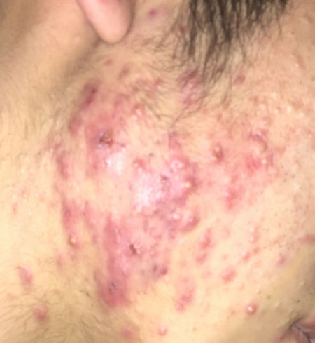 痘痘都是去哪里治好的,三角区长痘痘治疗的全部过程