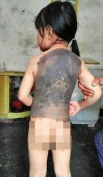 孩子有胎记如何避免孩子自卑,宝宝长胎记怎样避免心理健康