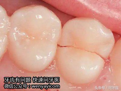 牙齿上有裂纹怎么办,牙齿上有裂纹怎么治