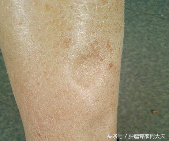 前列腺癌晚期贫血腿肿怎么办,前列腺癌晚期一侧腿肿怎么办