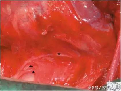 喉返神经的解剖视频,损伤喉上神经和喉返神经的区别