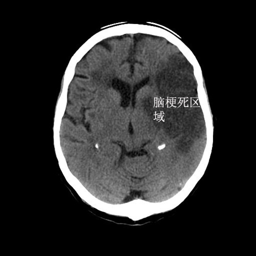 老年人头痛想吐什么原因,老人呕吐是中风前征兆吗