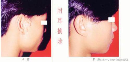 新生儿耳朵长个小附耳怎么造成的,5岁男童耳朵长副耳要住院吗