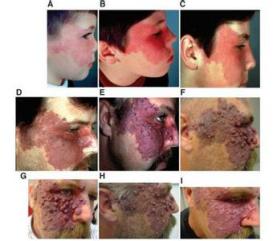 鲜红斑痣到底需不需要治疗？这个难题有答案了