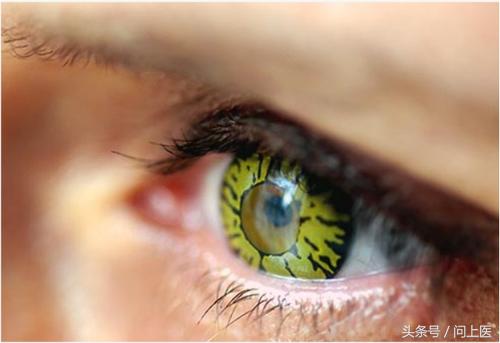 佩戴隐形眼镜有什么注意事项,隐形眼镜佩戴注意事项