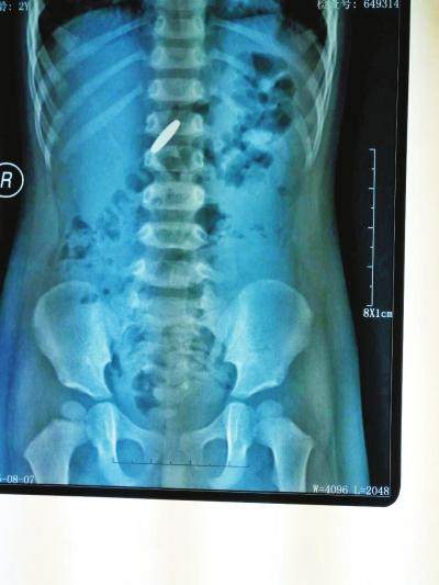 儿童误吞玩具在胃里,小孩误吞了玩具要怎么检查