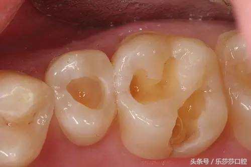 大牙上有黑线是怎么回事,孩子大牙上有黑线怎么办