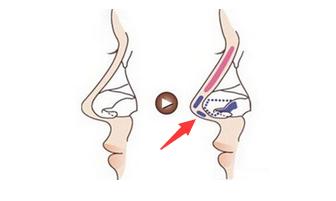 耳软骨隆鼻垫鼻尖缺点,隆鼻耳软骨垫鼻尖发白
