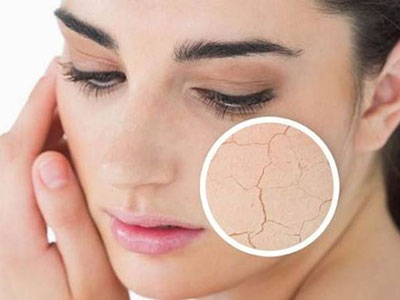 皮肤皲裂中医医案,国医草本皲裂膏