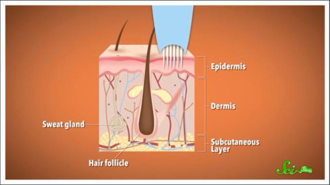 怎样可以去除纹身,怎么去除纹身
