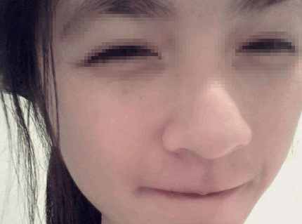 怎么按摩可缩小鼻头,鼻头肥大怎么按摩变小